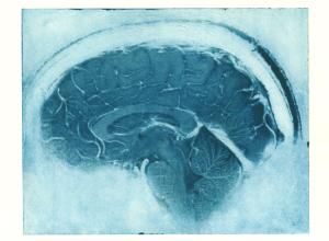 Daniel's Brain, Sagittal MRI view of a neurologist's MRI. Courtesy Elizabeth Jameson