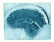 Daniel's Brain, Sagittal MRI view of a neurologist's MRI. Courtesy Elizabeth Jameson