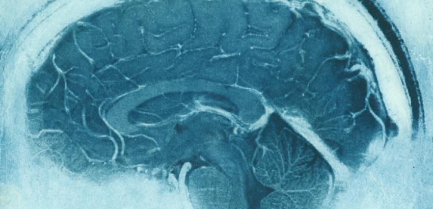 Daniel's Brain, Sagittal MRI view of a neurologist's MRI. Courtesy Elizabeth Jameson